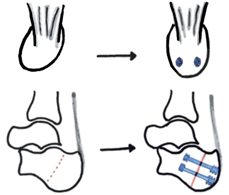 tekening CALCANEUS OSTEOTOMIE